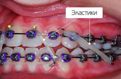 Іригатор - ефективна гігієна ротової порожнини.
