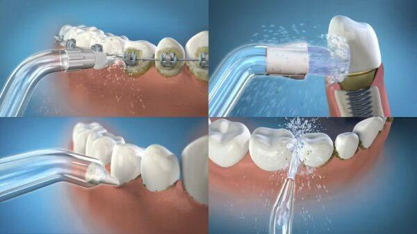 Профілактика карієсу з іригатором