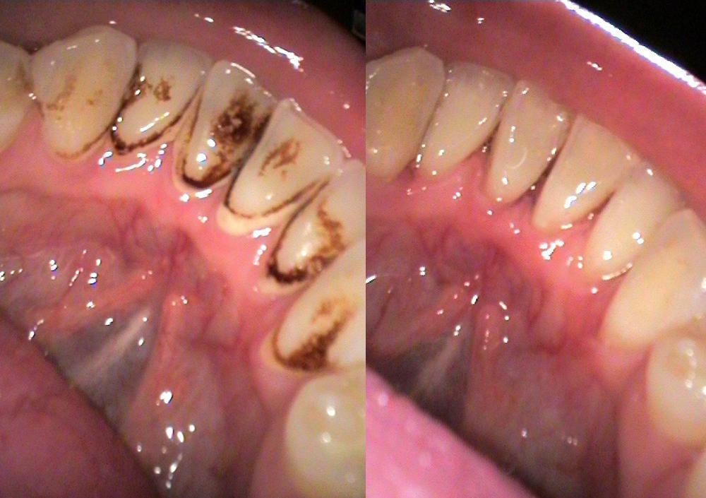 Догляд за зубами з металокераміки