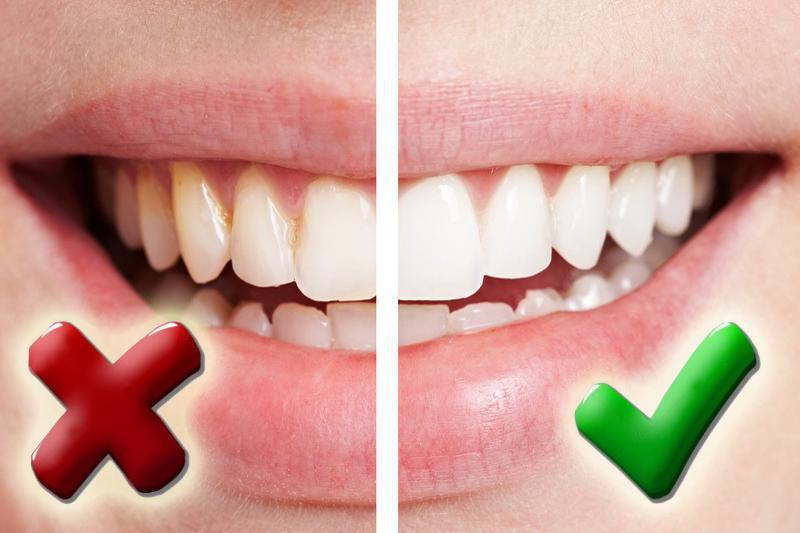 Слиннокам'яна хвороба: що це та чим небезпечна?